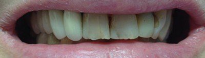 Decayed and damaged front teeth