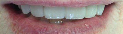 Closeup of brilliant white teeth