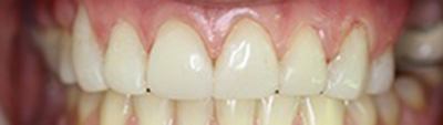 Closeup of beautiful shaped and colored healthy smile