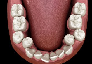Illustration of crooked teeth