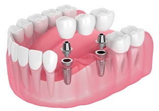 Exploded illustration of implants with dental bridge