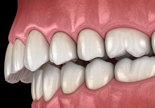 Illustration of an overbite