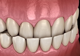 Illustration of an underbite