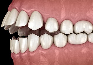 Illustration of an open bite