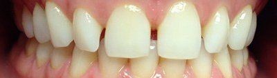 Smile with large gaps between teeth