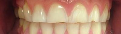 Severely worn short looking front teeth