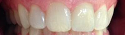 Smile with bright white healthy teeth