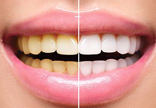 Closeup of teeth half before and half after whitening