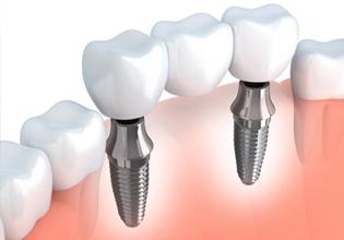 Diagram of an implant supported bridge