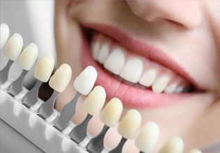 Color-matching guide for dental restoration