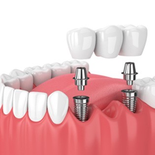 illustration implant dental bridge in Ware