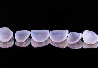 dental veneers