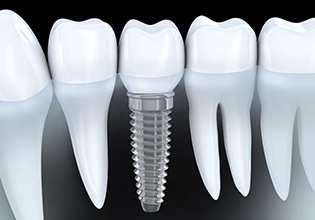 Animation of implant retained dental crown