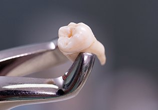 Extracted tooth