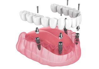 Illustration of Teeth-In-A-Day implants against white background