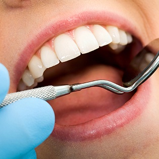 Closeup of smile during dental exam