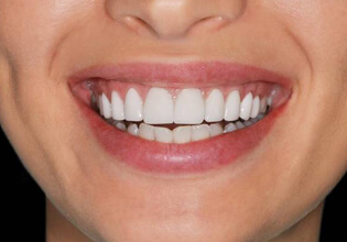 Healthy Teeth and Gums