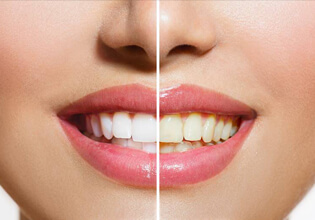 Teeth whitening before and after