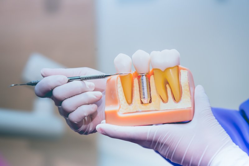 a dentist showing a model of dental implants in Ware