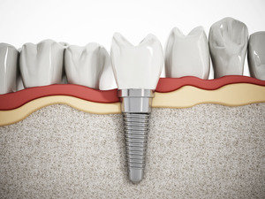 Illustration of dental implant in jawbone